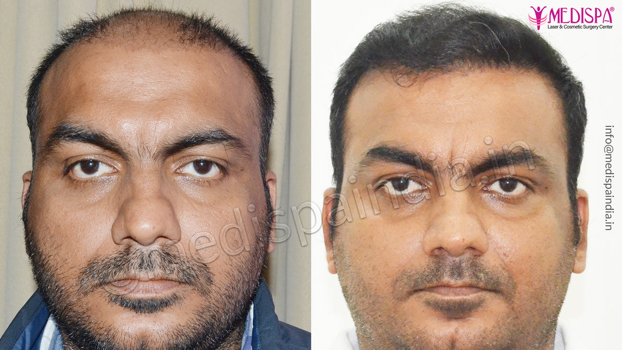 hair transplant in kota rajasthan