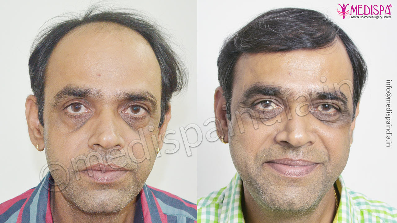 hair transplant in kota