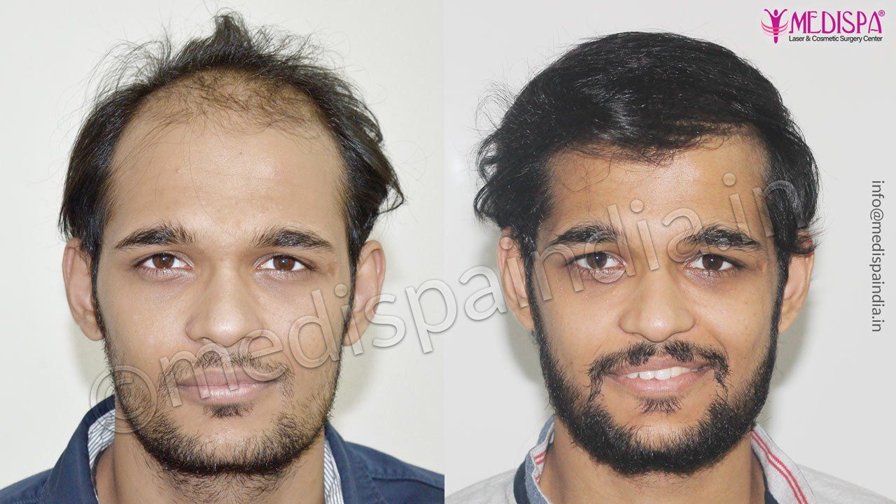 celebrity hair transplant result 