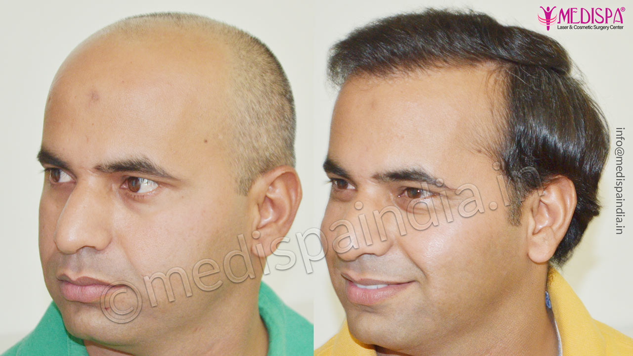 hair transplant cost in india