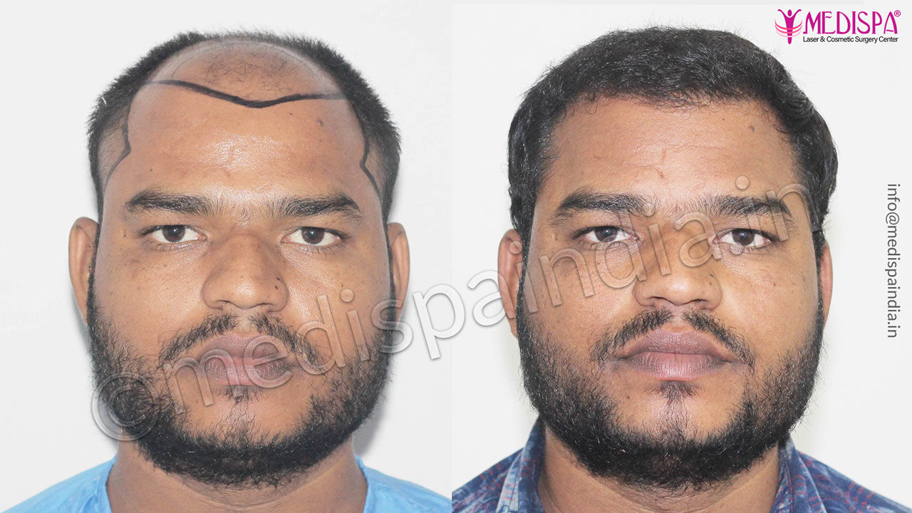 hair transplant cost in surat