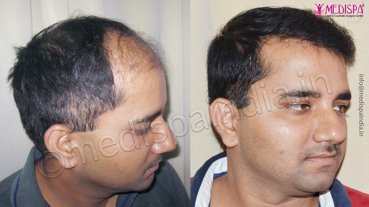 hair transplant in turkey