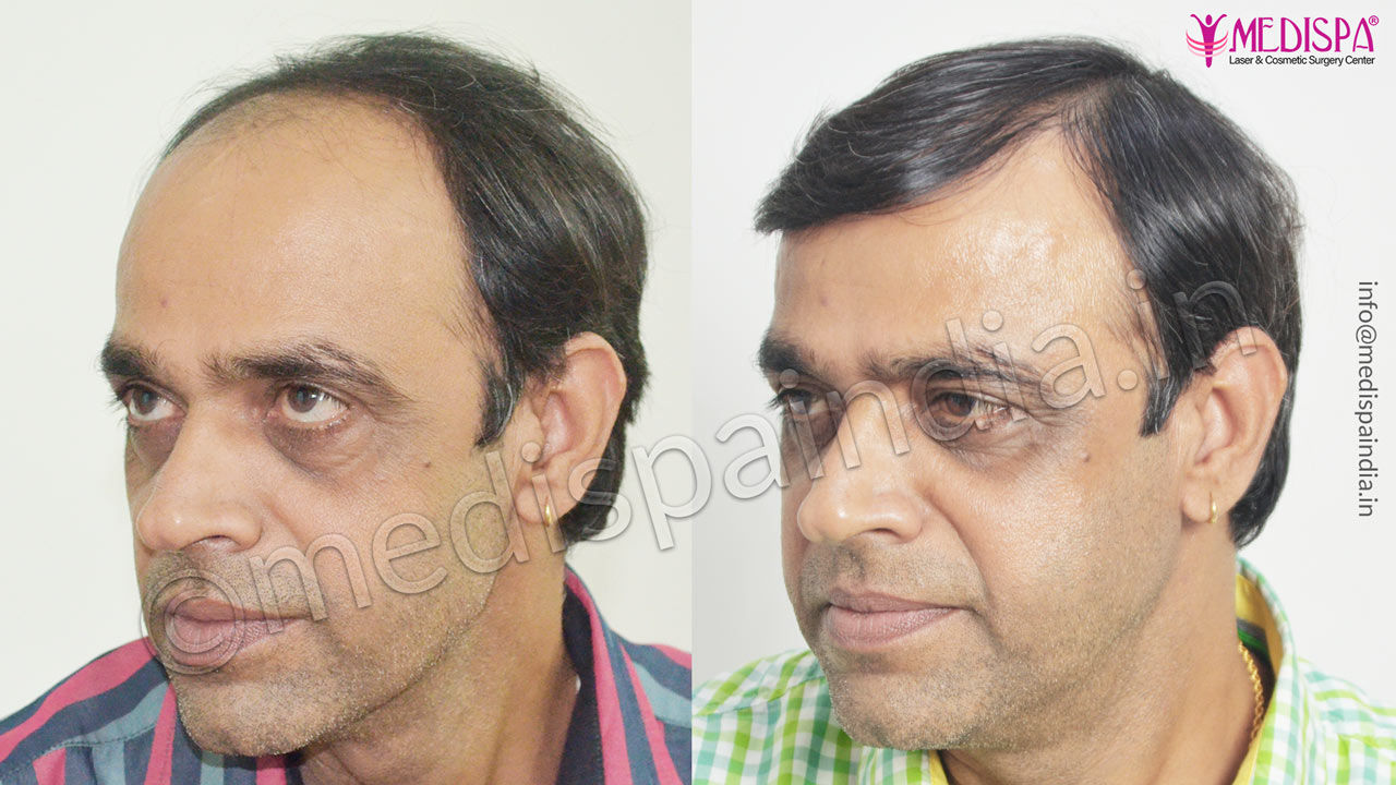 hair transplant in udaipur