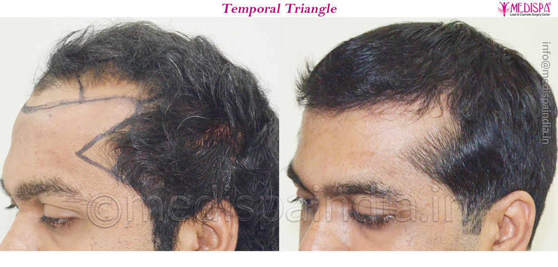 hair transplant in united kingdom