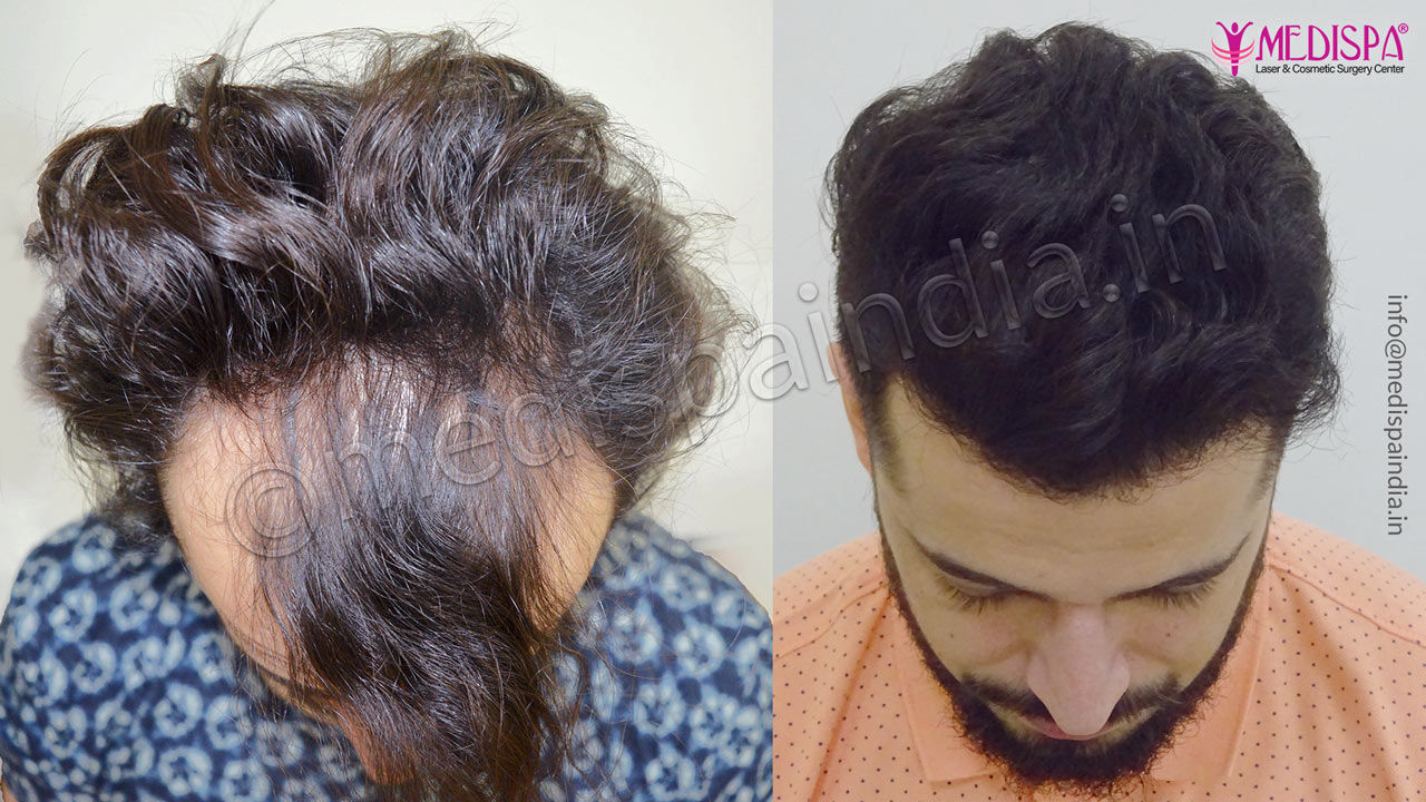 hair transplant in united states of america