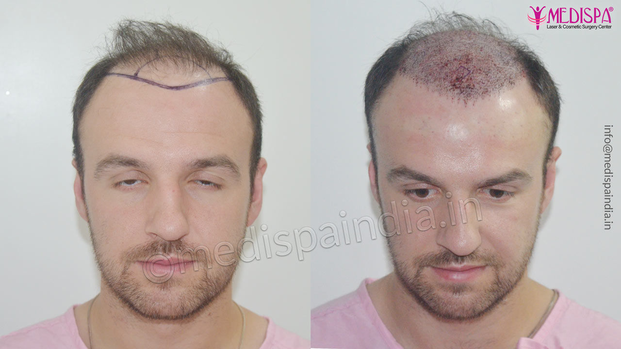 celebrity hair transplant india