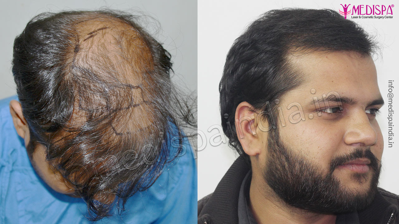 hair transplant jaipur cost india