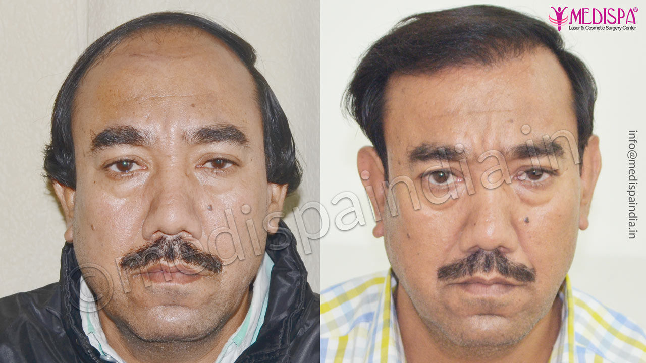 hair transplant jammu kashmir