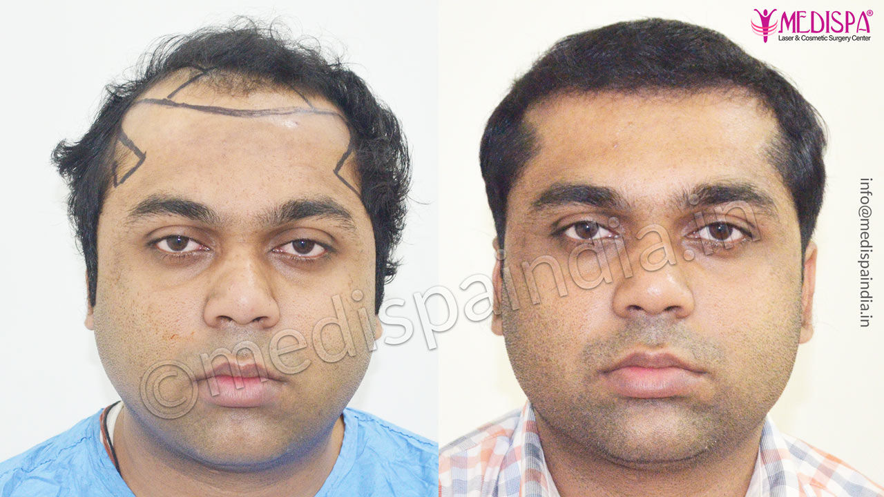 celebrity hair transplant result 