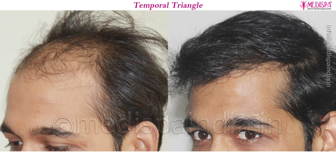 hair transplant newzealand