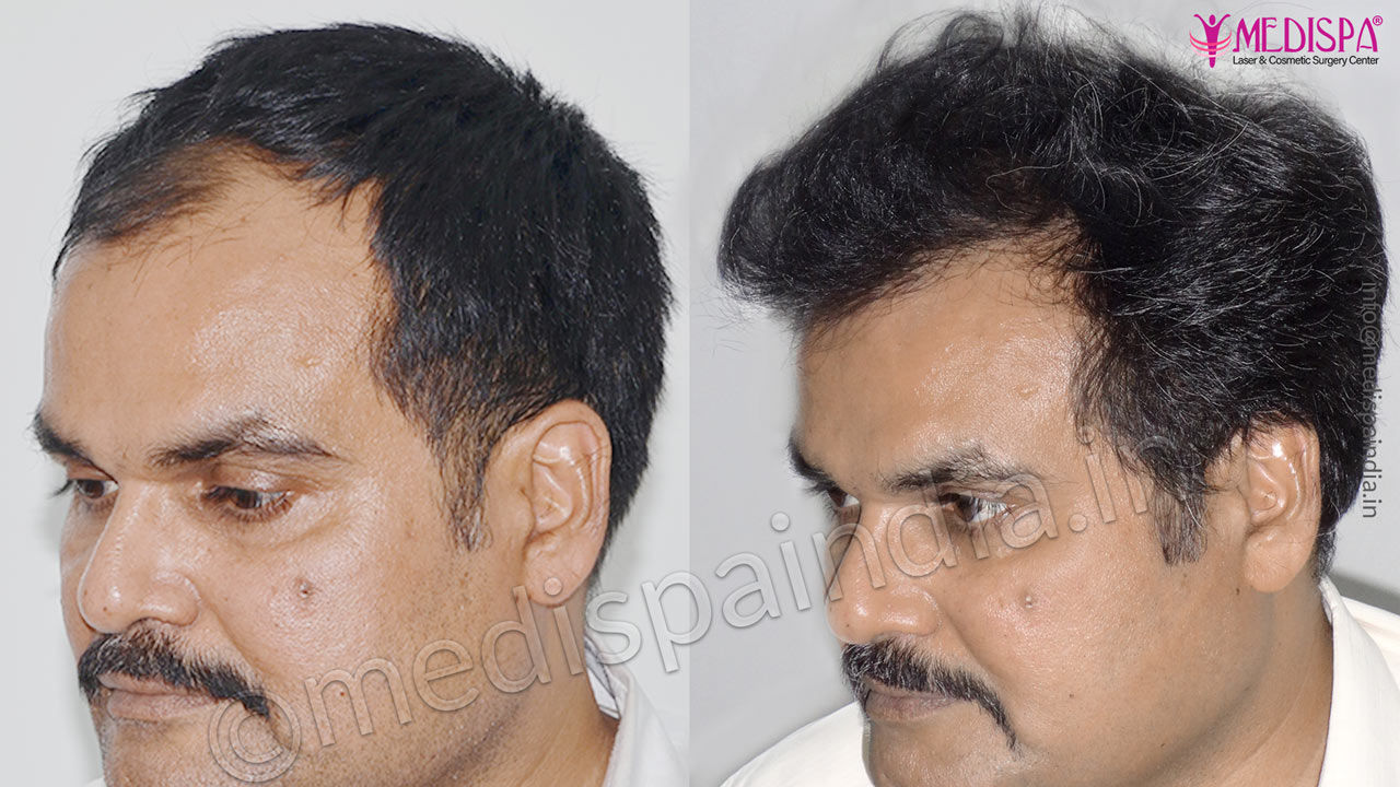 hair transplant after 6 months