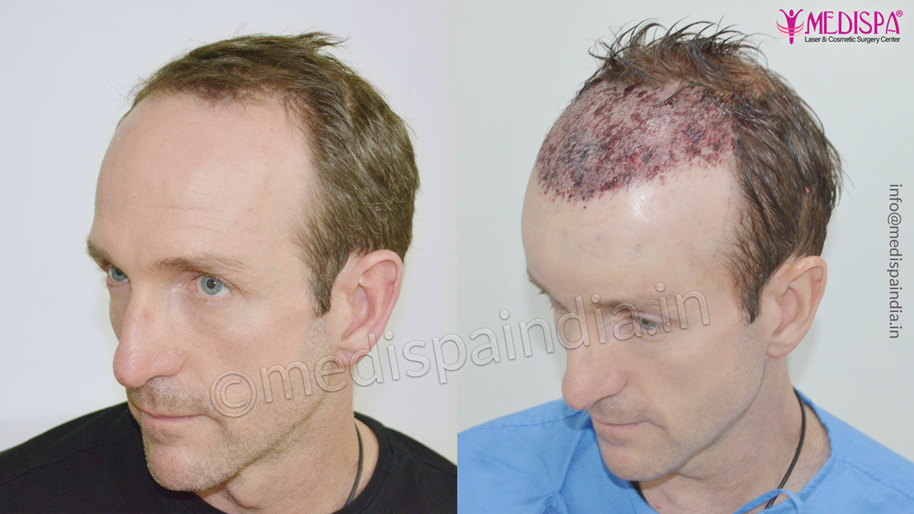 hair transplant results australia