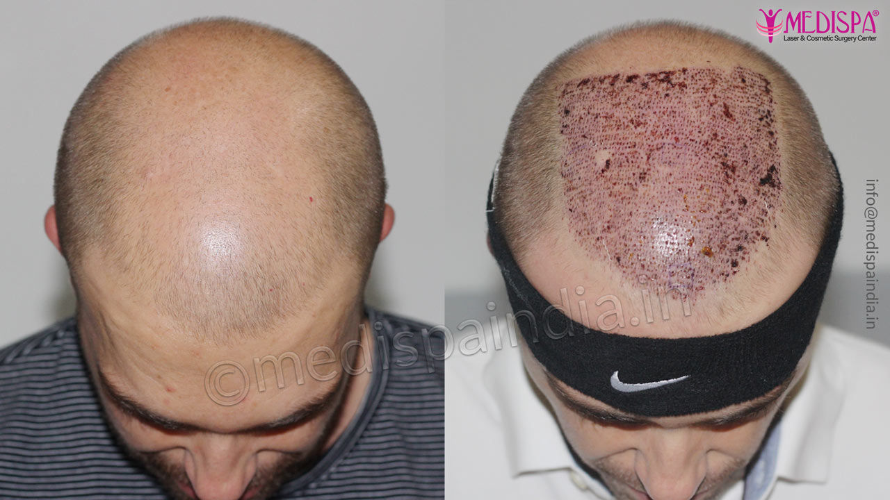 hair transplant results australian