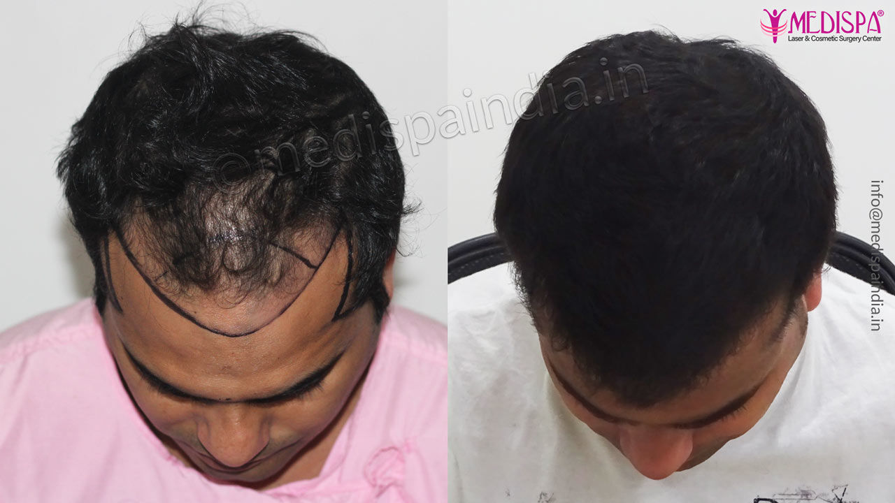 hair transplant before and after results