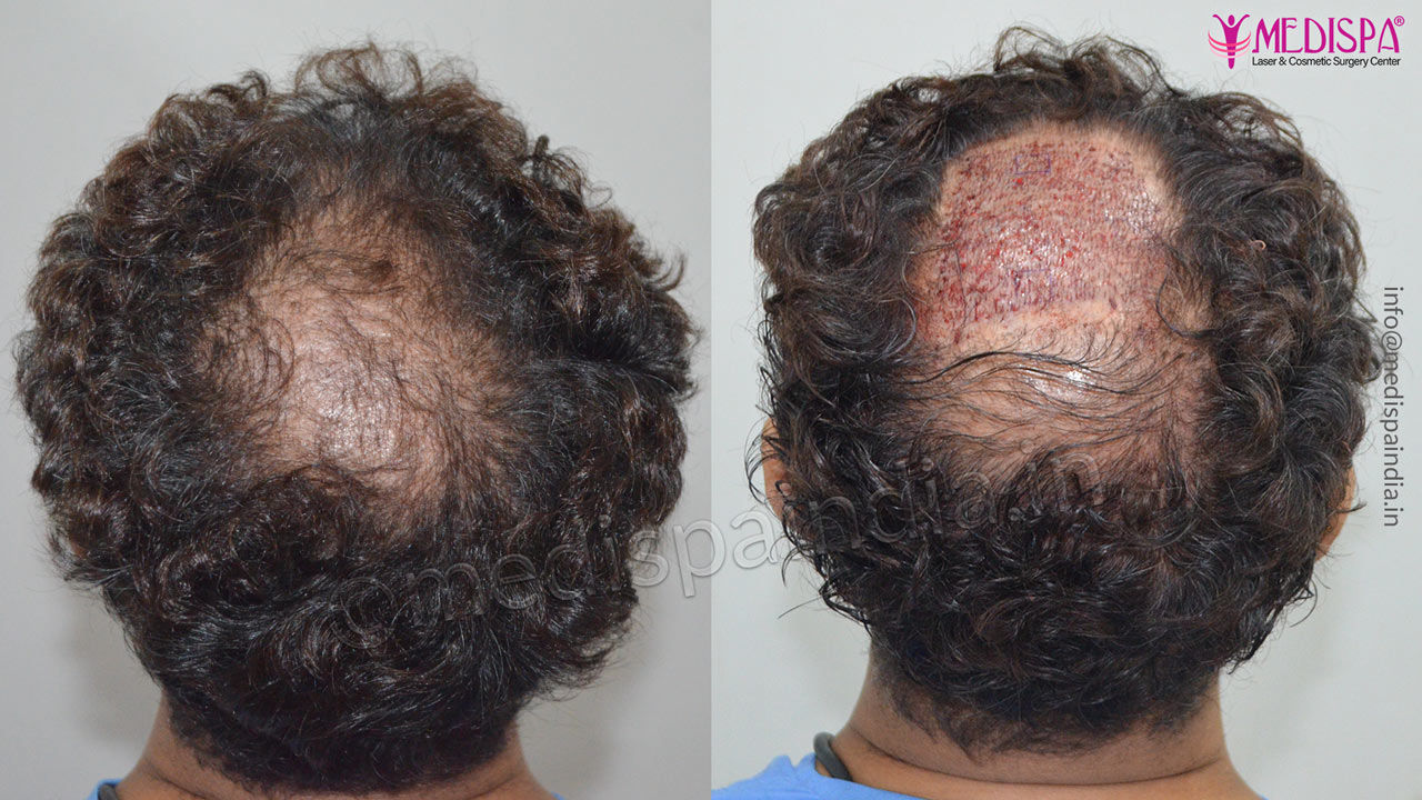 hair transplant results malaysia