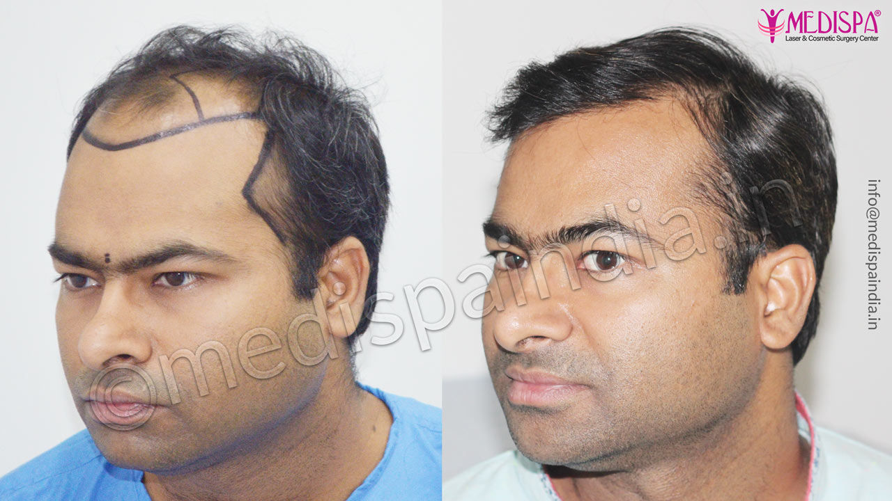 hair transplant results uk