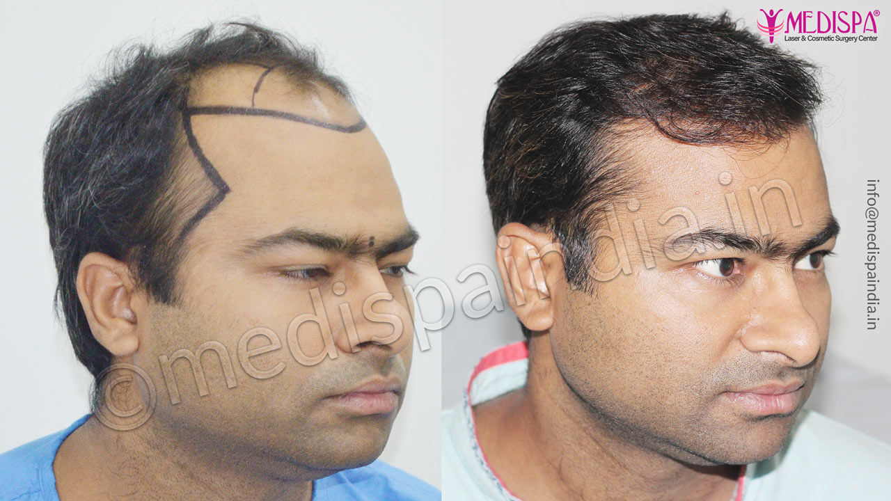 hair transplant results usa