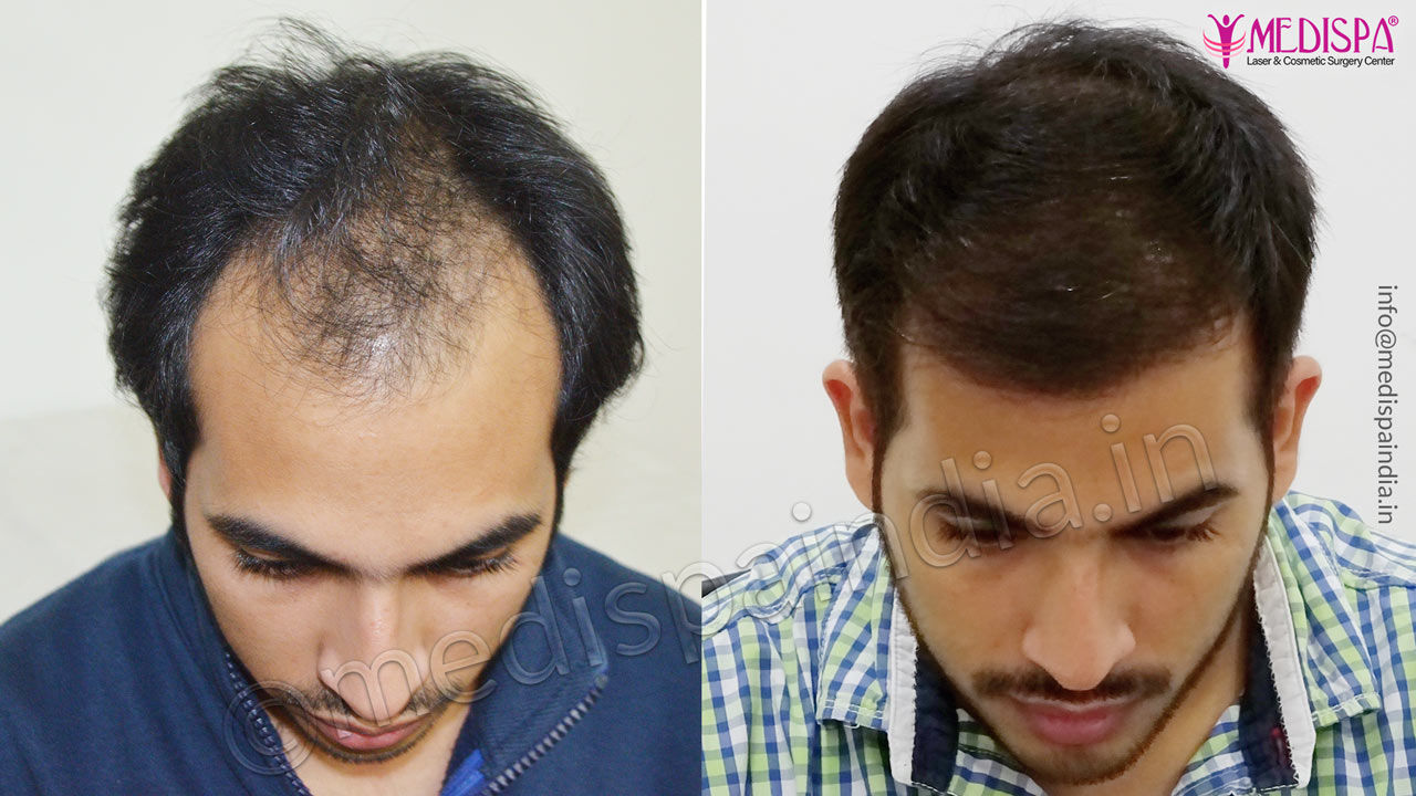 hair transplant rewari