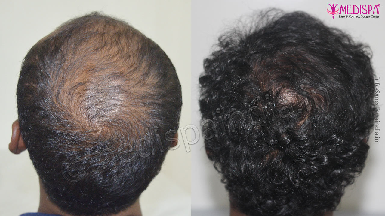 hair transplant surgeons in bengaluru