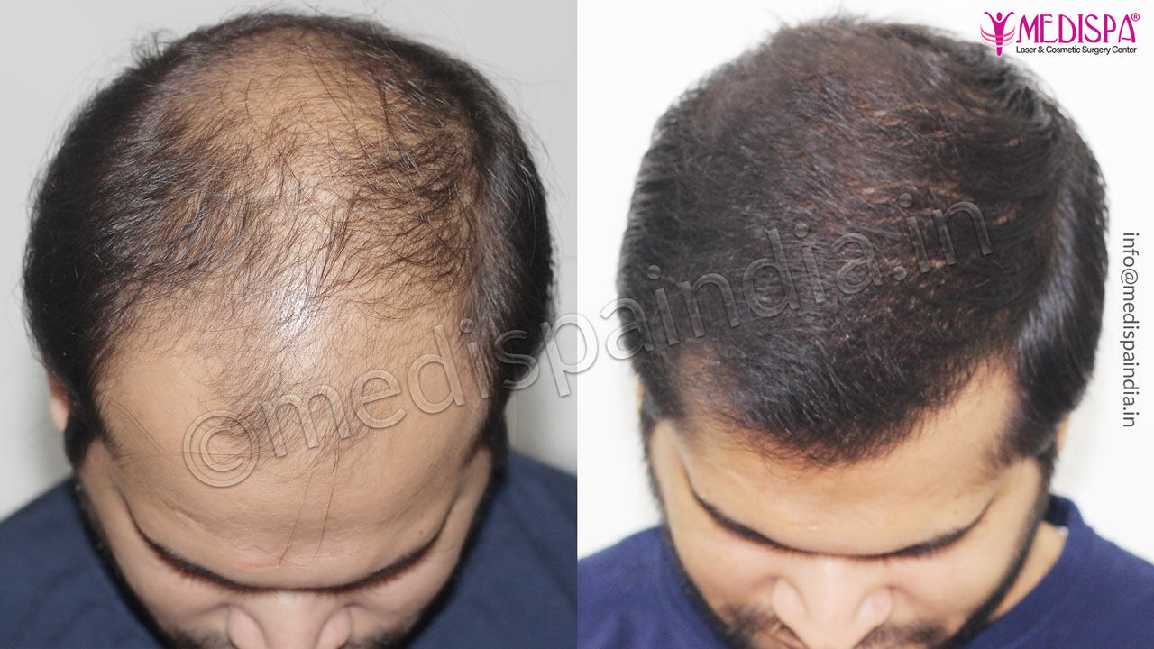 hair transplant surgeons in bikaner