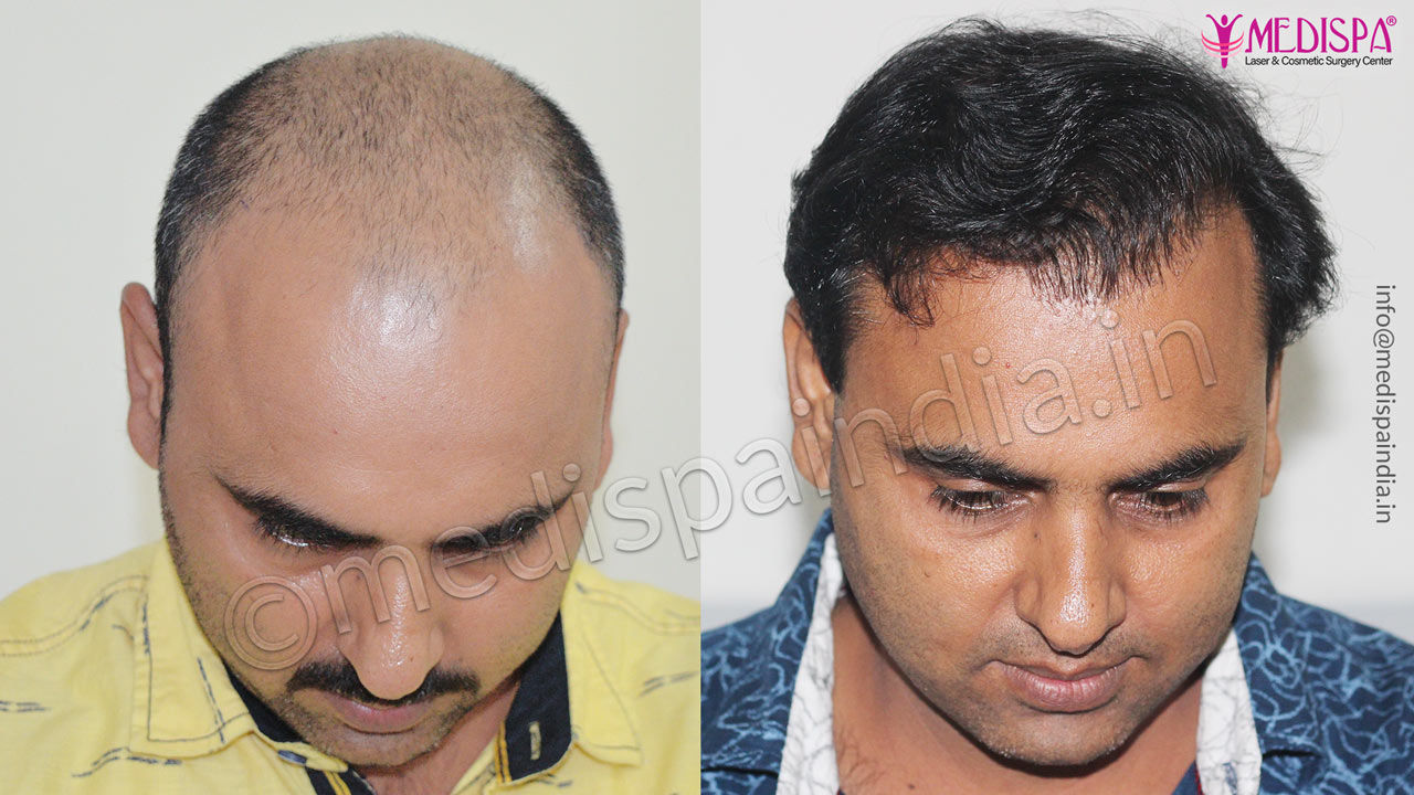 hair transplant surgeons in faridabad