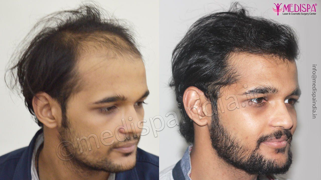 Combination of FUT & FUE Hair Transplant Results, Delhi