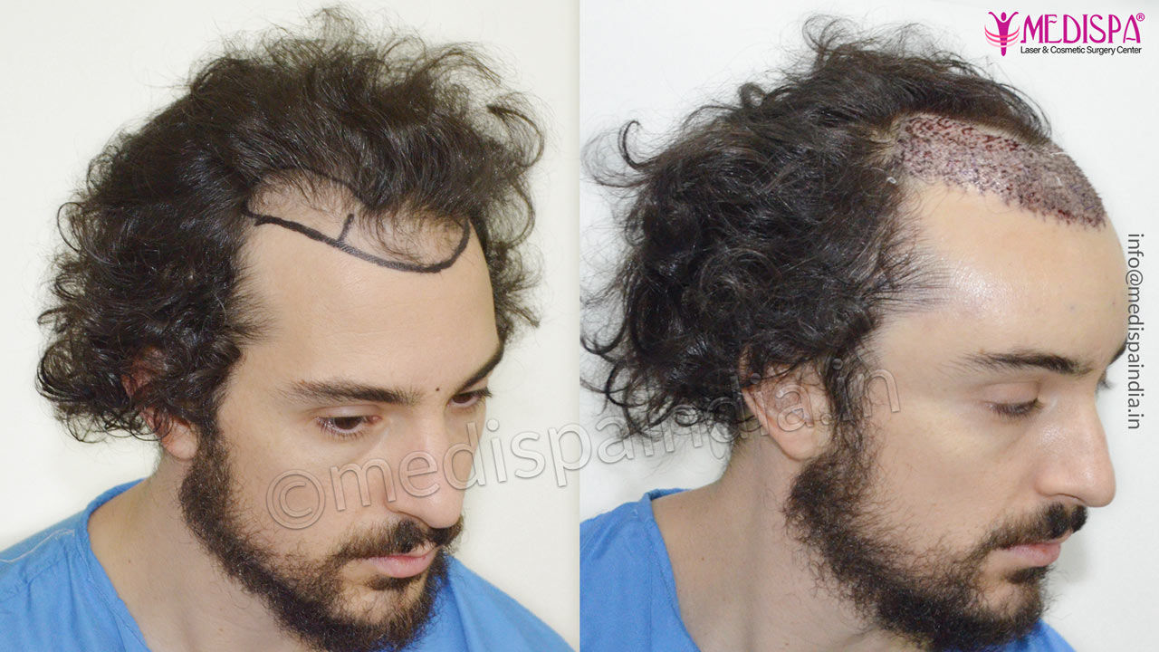 hair transplant usa result