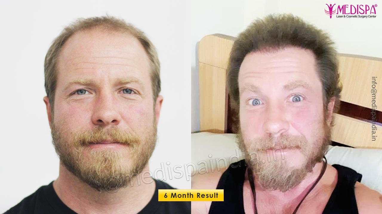 hair transplant usa results