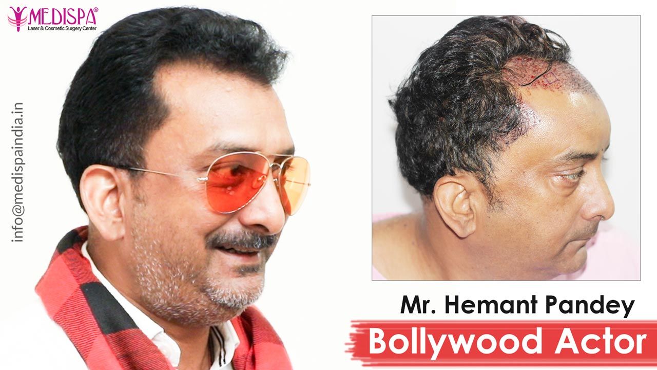 hemant pandey actor hair transplant