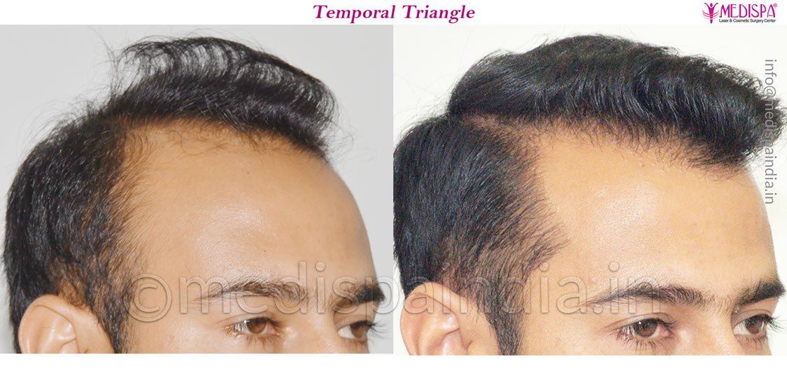 hyderabad hair restoration