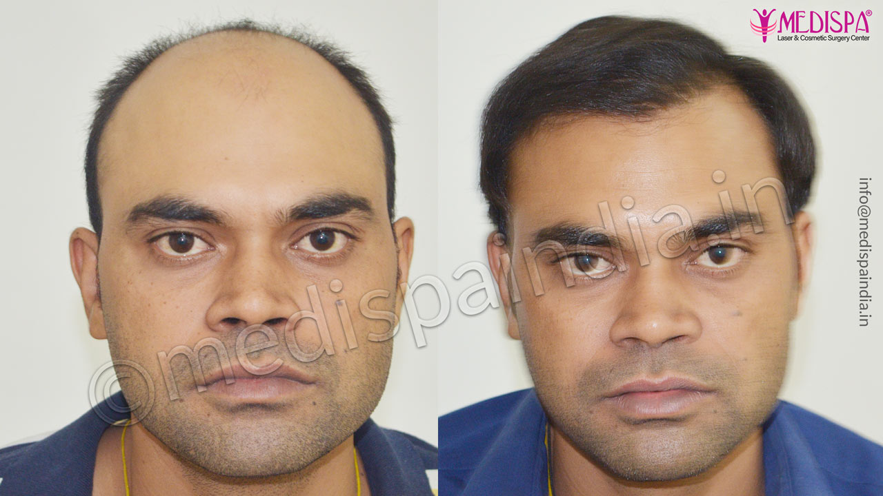 celebrity hair transplant result 