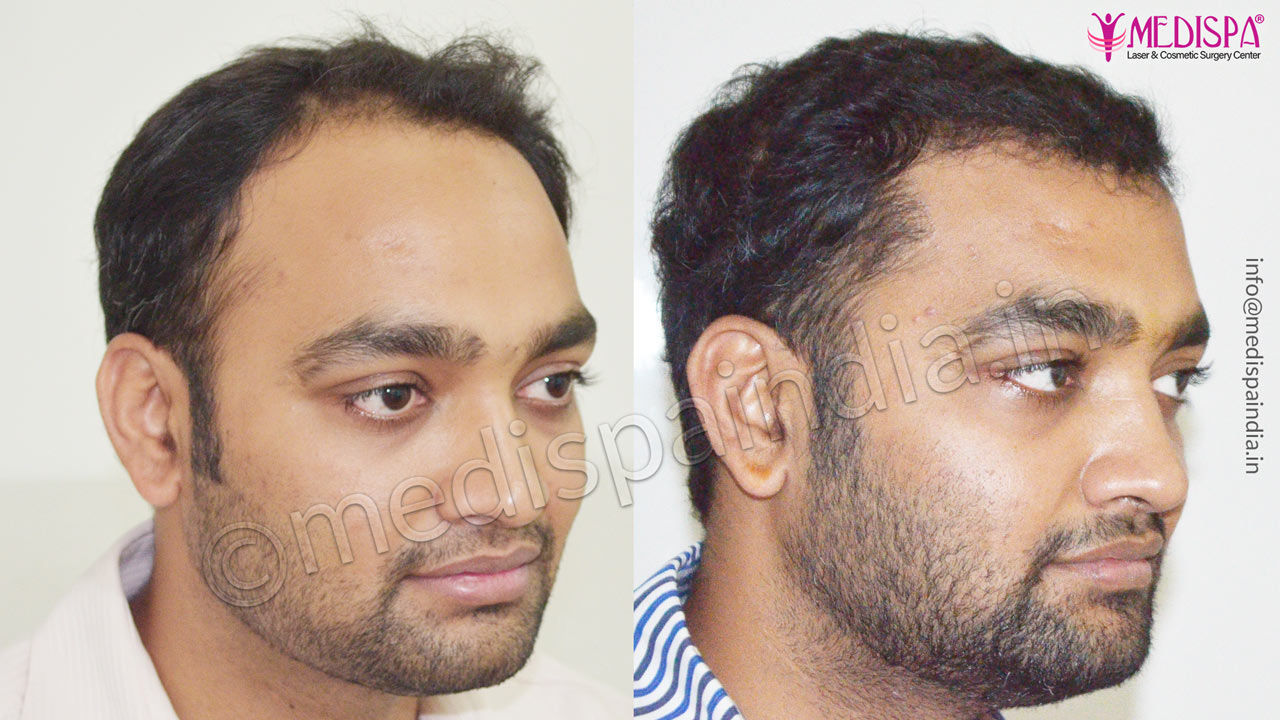 kolkata hair transplant cost