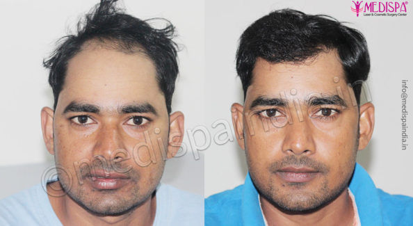 male hair transplant before after