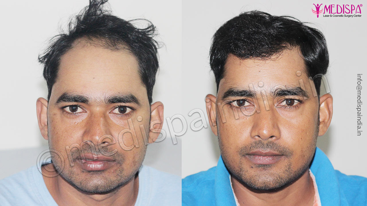 male hair transplant before after