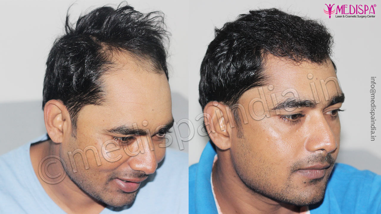 male hair transplant before and after