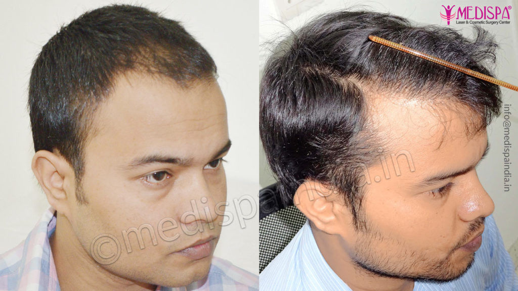 male hair transplant results jaipur