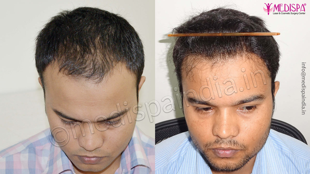 male hair transplant results