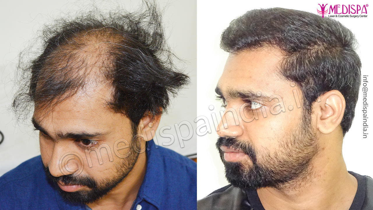 medispa hair transplant cost