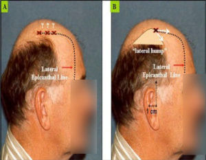 placement of temporal triangle