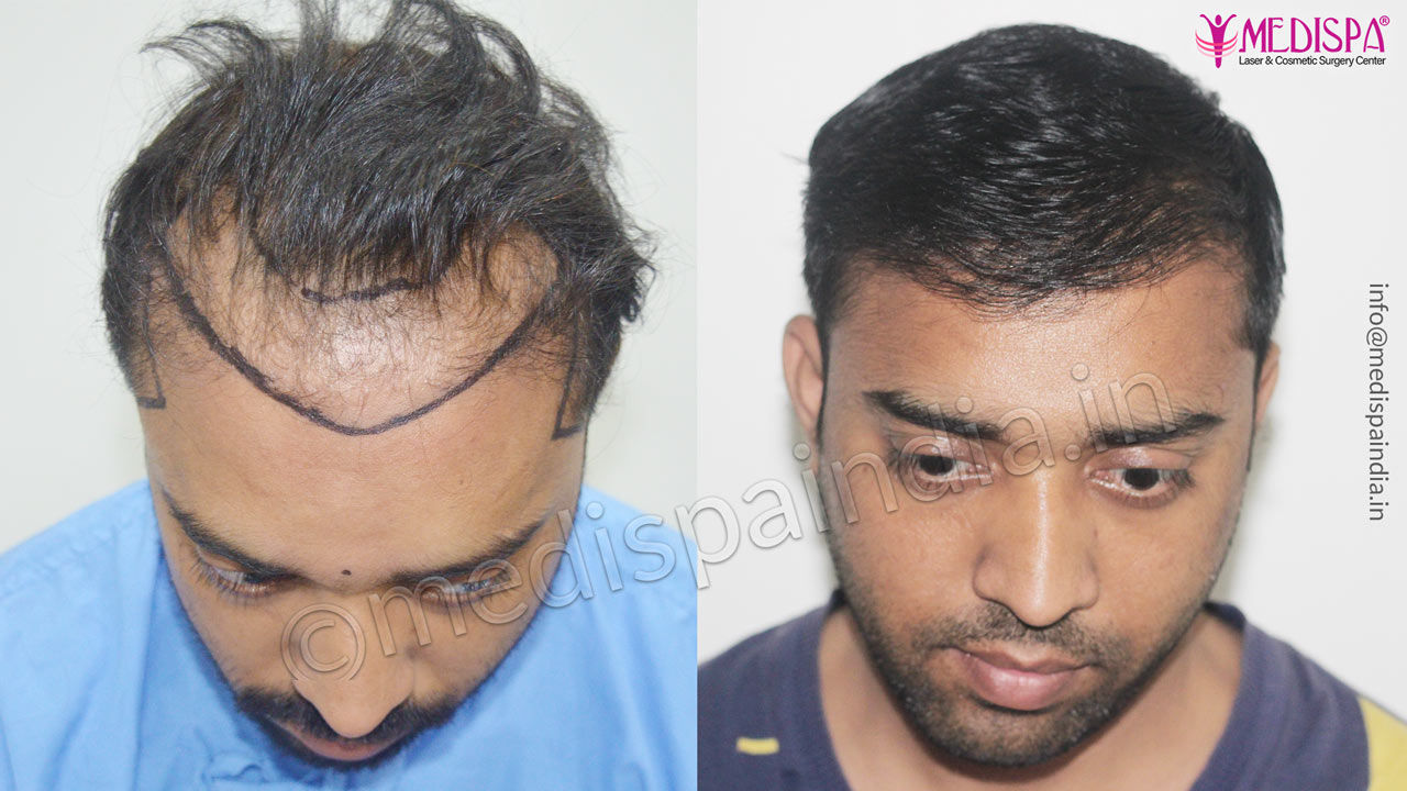 revision hair transplant pune