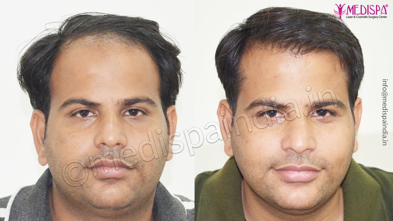 top 5 hair transplant surgeons