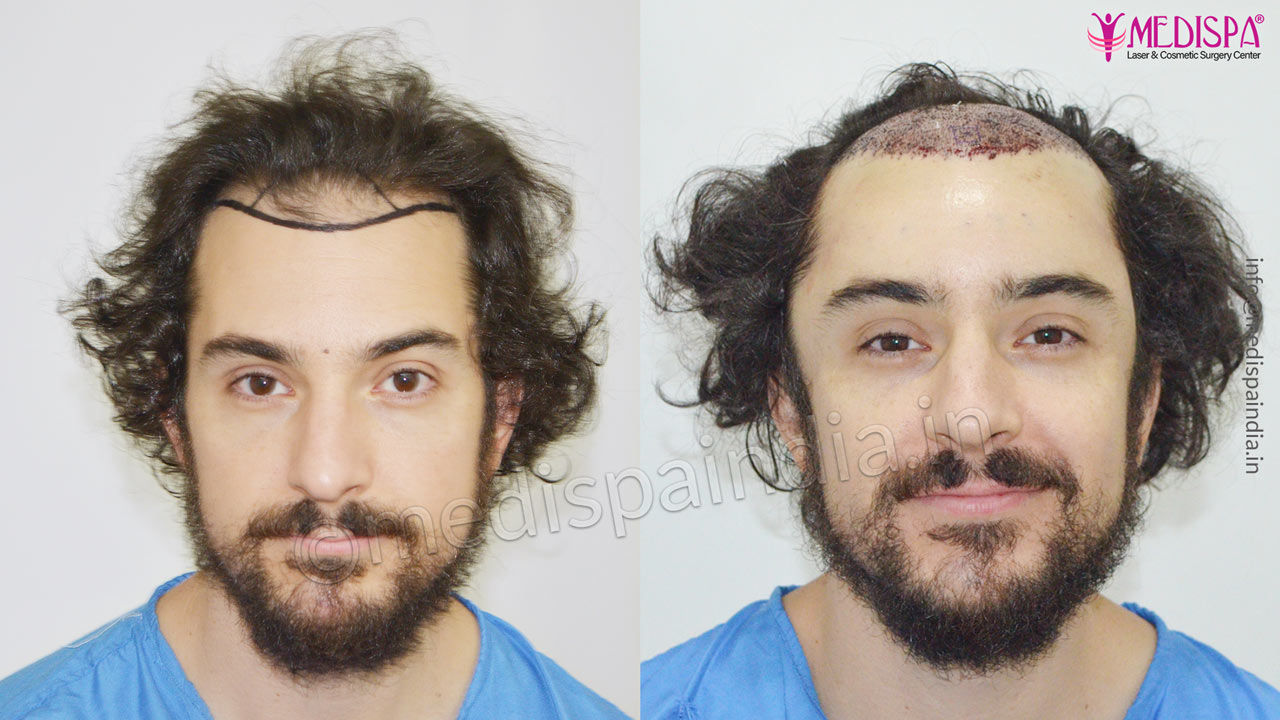 usa hair transplant results