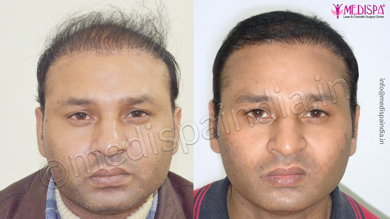 wrong hair transplant correction bangalore