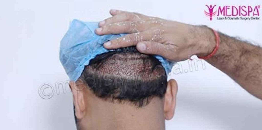 best-hair-transplant-results-india