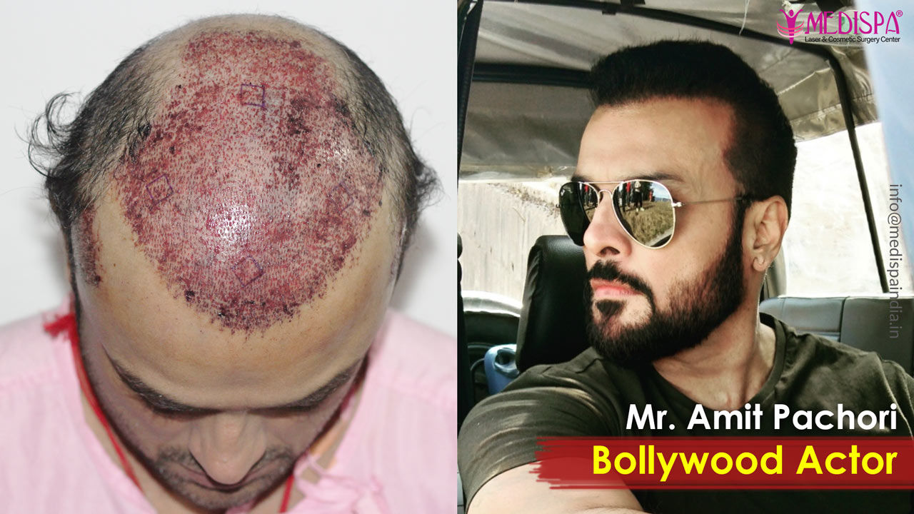 celebrity hair transplant india