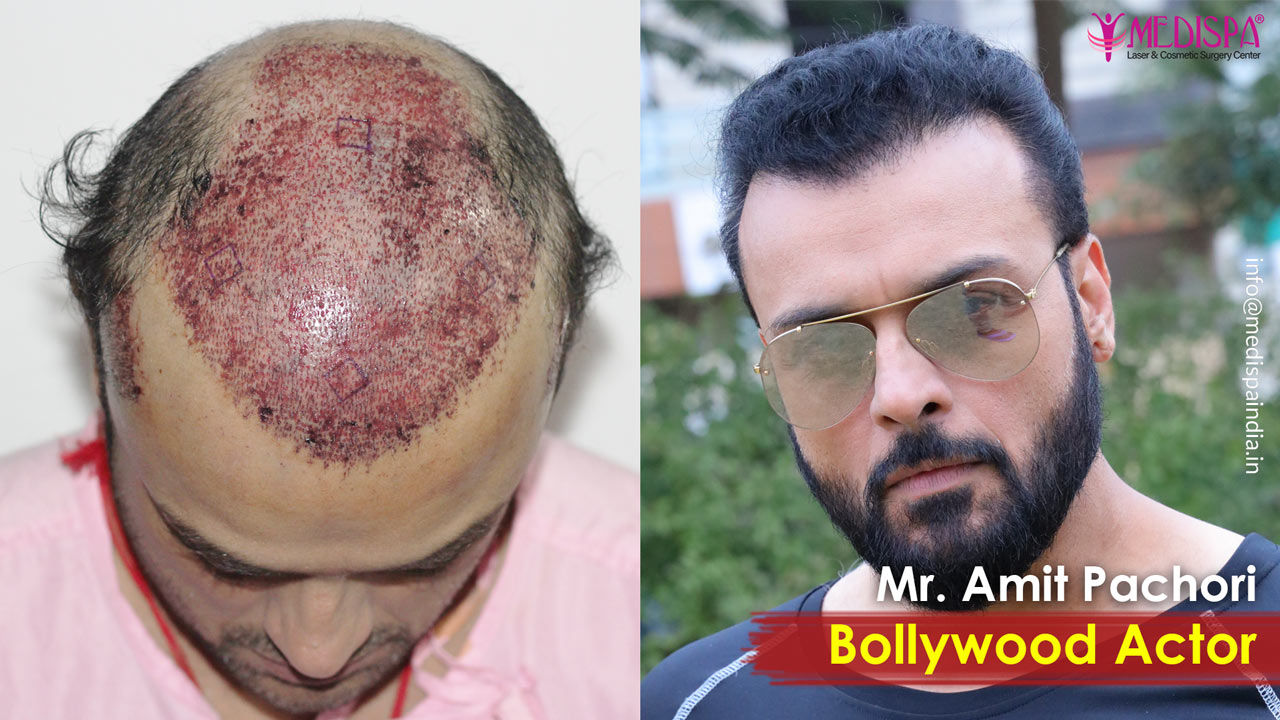 celebrity hair transplant jaipur