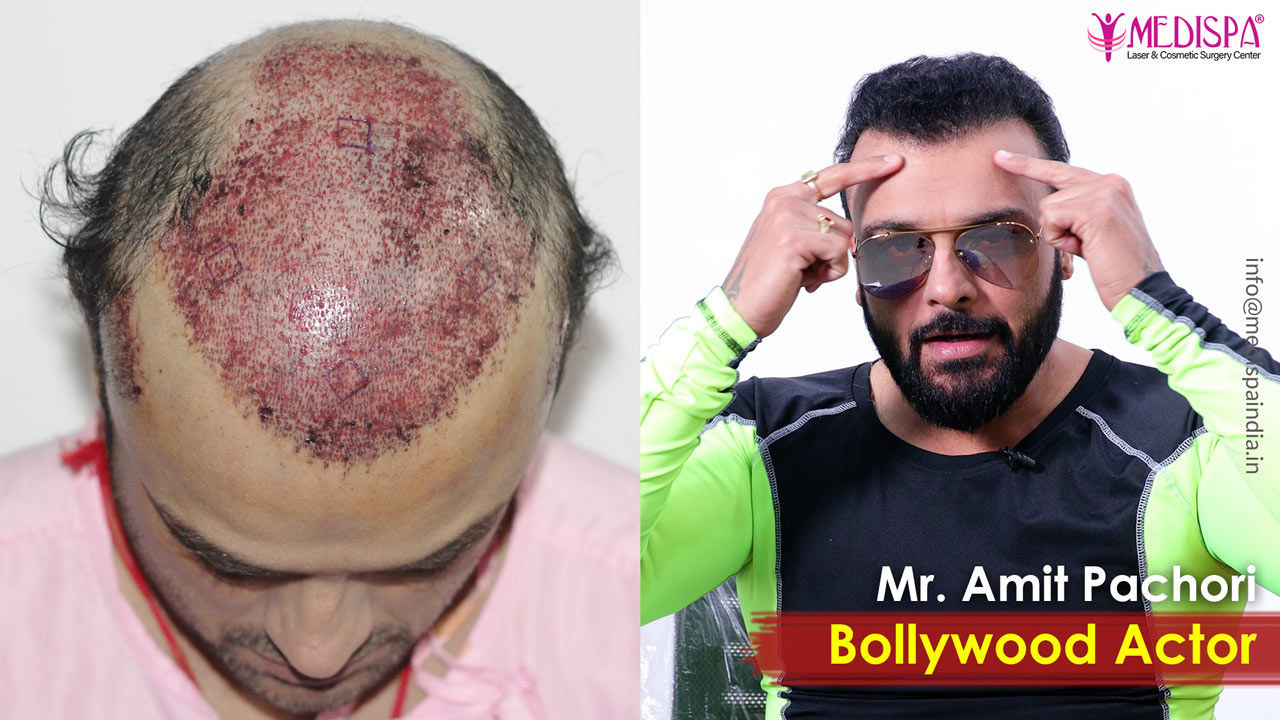 celebrities hair transplant