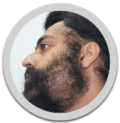 hair transplant in jaipur