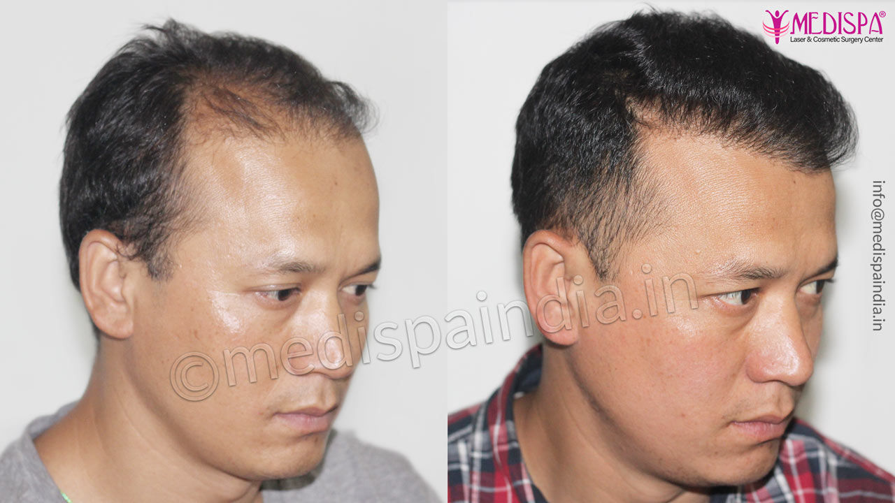 hair transplant results bikaner