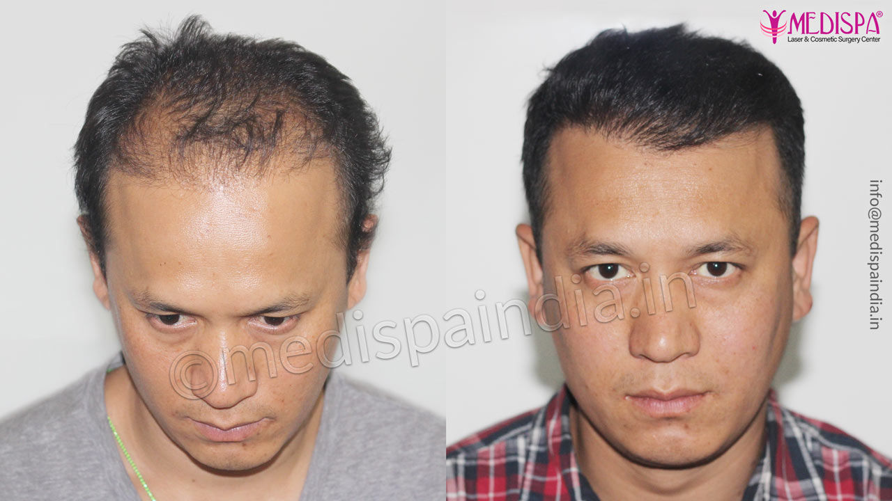 hair transplant cost in India